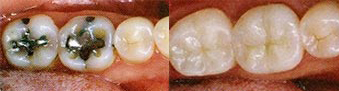 Tooth-Colored Fillings (Composites)